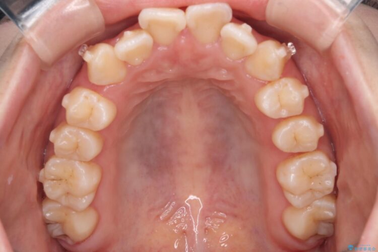 インビザラインでオープンバイトの改善 治療途中画像