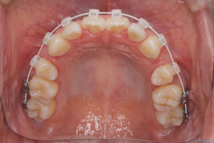 審美装置で前歯のデコボコを改善 治療途中画像