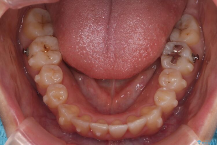 インビザラインでオープンバイトの改善 治療途中画像