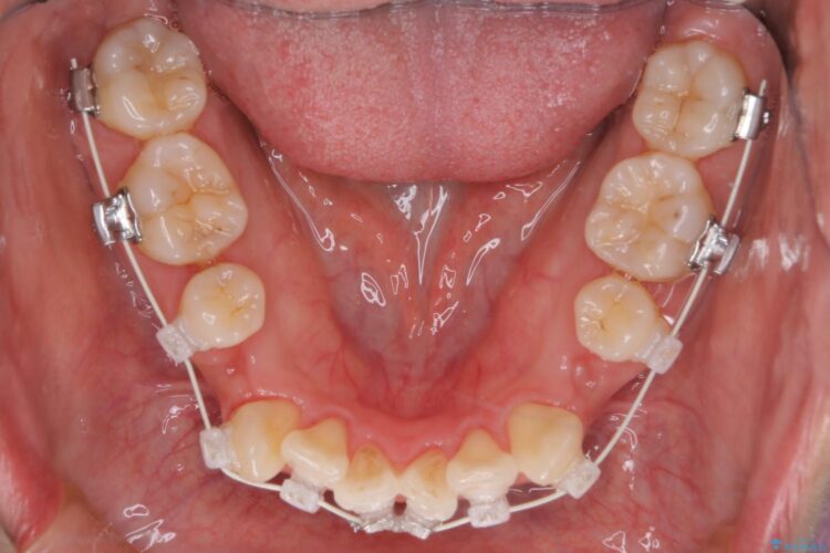 審美装置で前歯のデコボコを改善 治療途中画像