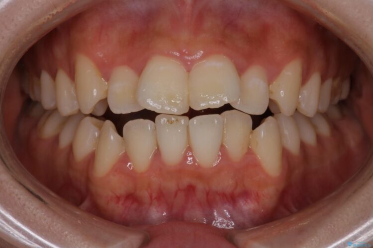 インビザラインでオープンバイトの改善 ビフォー
