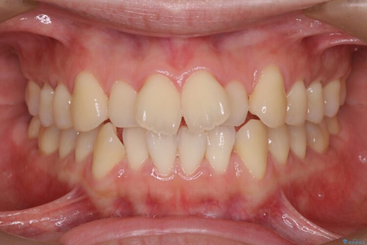 審美装置で前歯のデコボコを改善 ビフォー