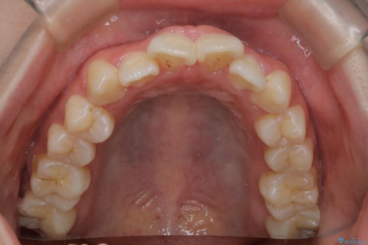 インビザラインでオープンバイトの改善 治療前画像