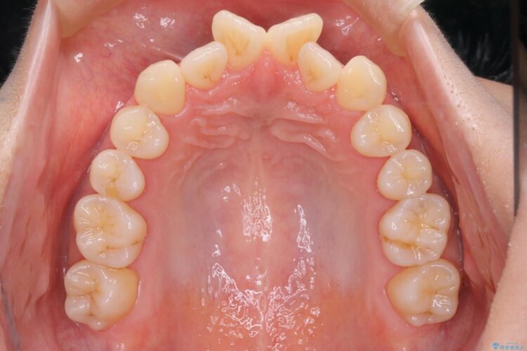 審美装置で前歯のデコボコを改善 治療前画像
