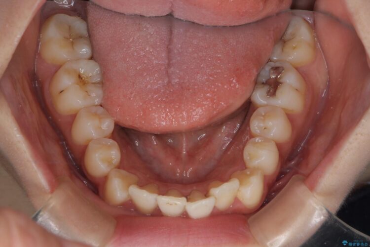 インビザラインでオープンバイトの改善 治療前画像