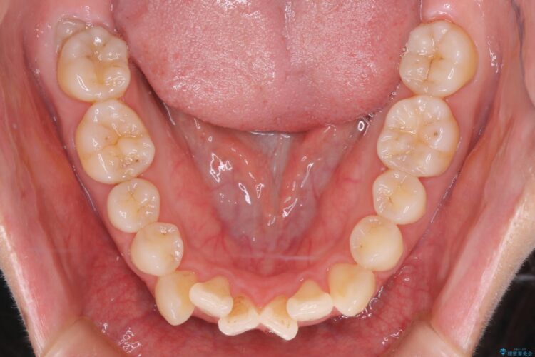 審美装置で前歯のデコボコを改善 治療前画像