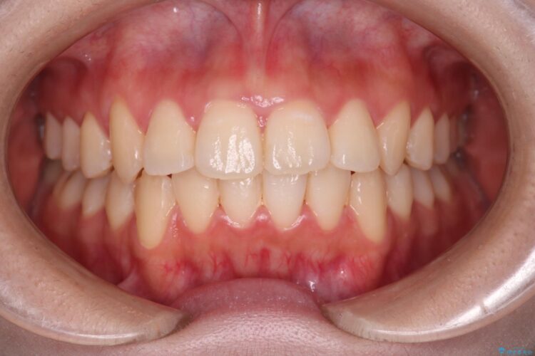 インビザラインでオープンバイトの改善 アフター