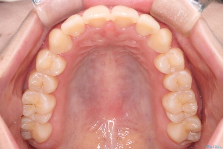 インビザラインでオープンバイトの改善 治療後画像