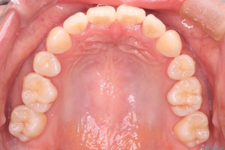 審美装置で前歯のデコボコを改善 治療後画像