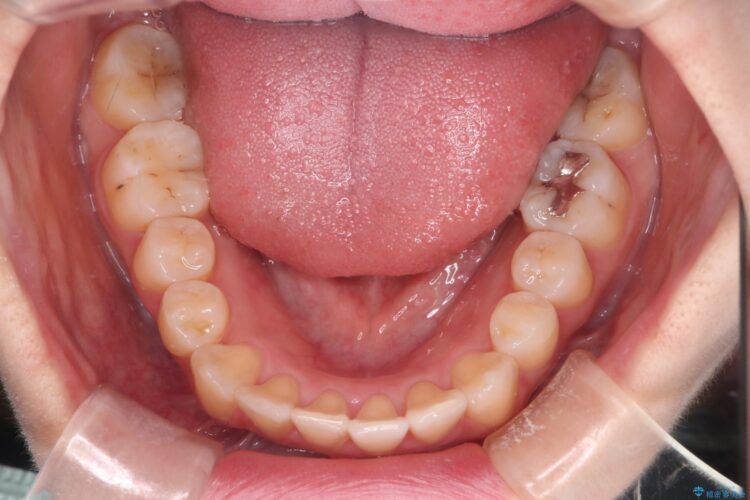 インビザラインでオープンバイトの改善 治療後画像