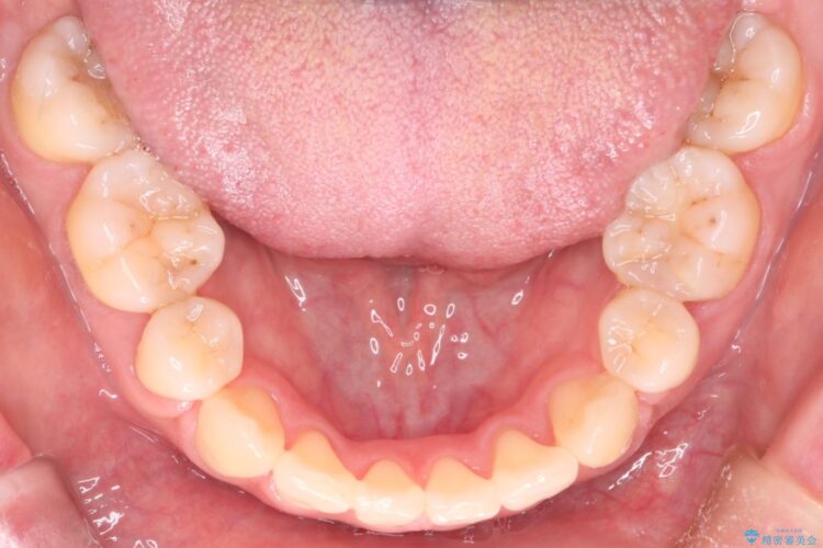 審美装置で前歯のデコボコを改善 治療後画像