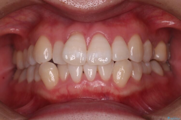矯正治療を始める前に白い歯に 治療後画像