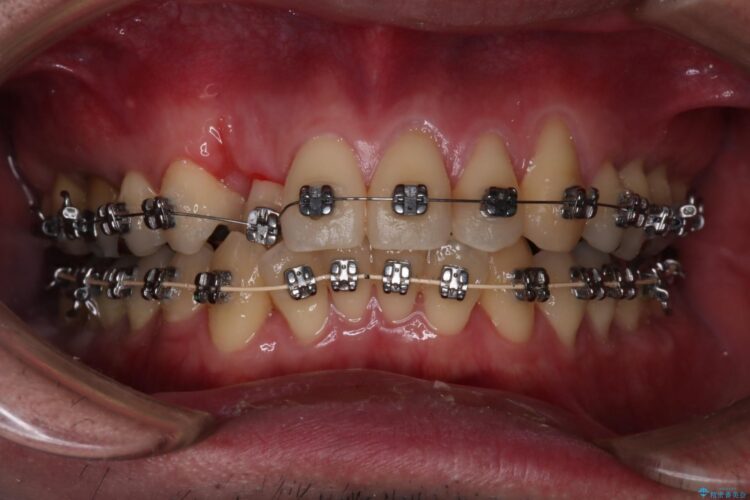 1本のみの抜歯でワイヤー矯正 治療途中画像