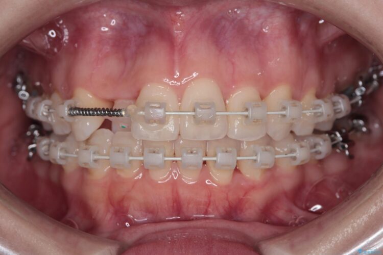 非抜歯で八重歯の改善 治療途中画像