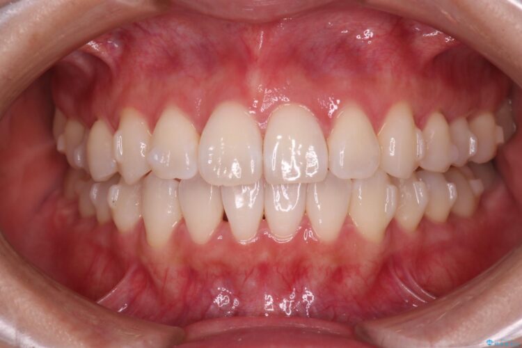 インビザラインで右側のガタつきの改善 治療途中画像