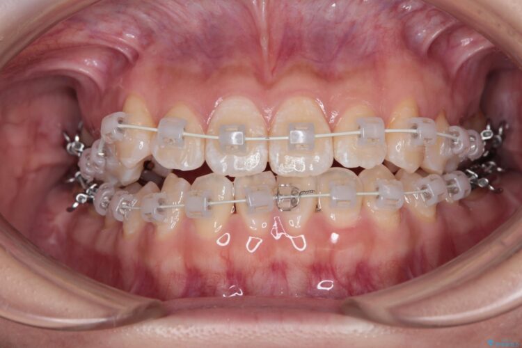 八重歯とがたつきを審美ワイヤーで治す 治療途中画像