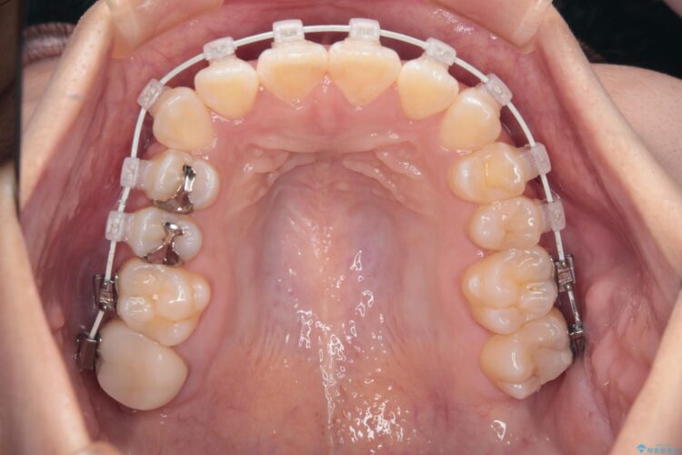 八重歯とがたつきを審美ワイヤーで治す 治療途中画像