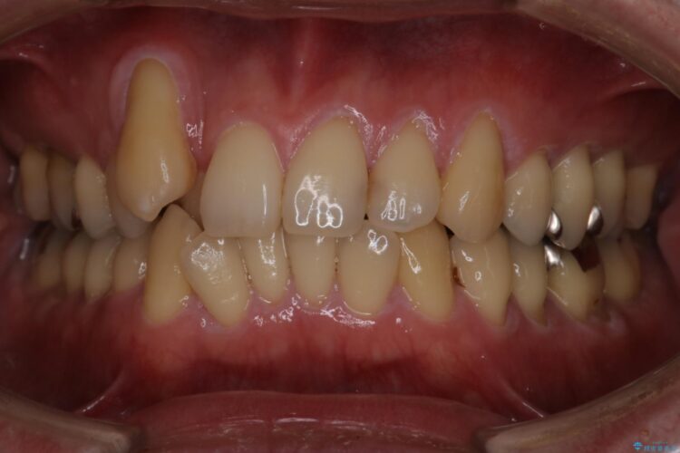 1本のみの抜歯でワイヤー矯正 ビフォー