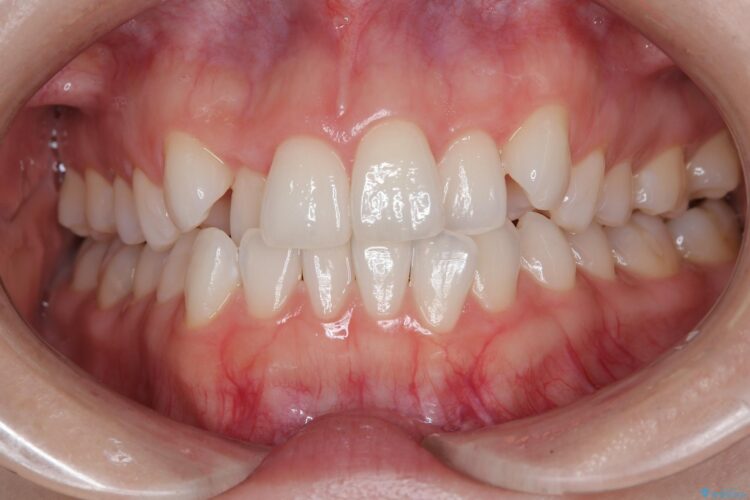 非抜歯で八重歯の改善 ビフォー