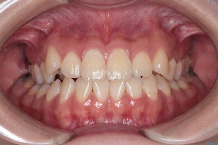 八重歯とがたつきを審美ワイヤーで治す ビフォー