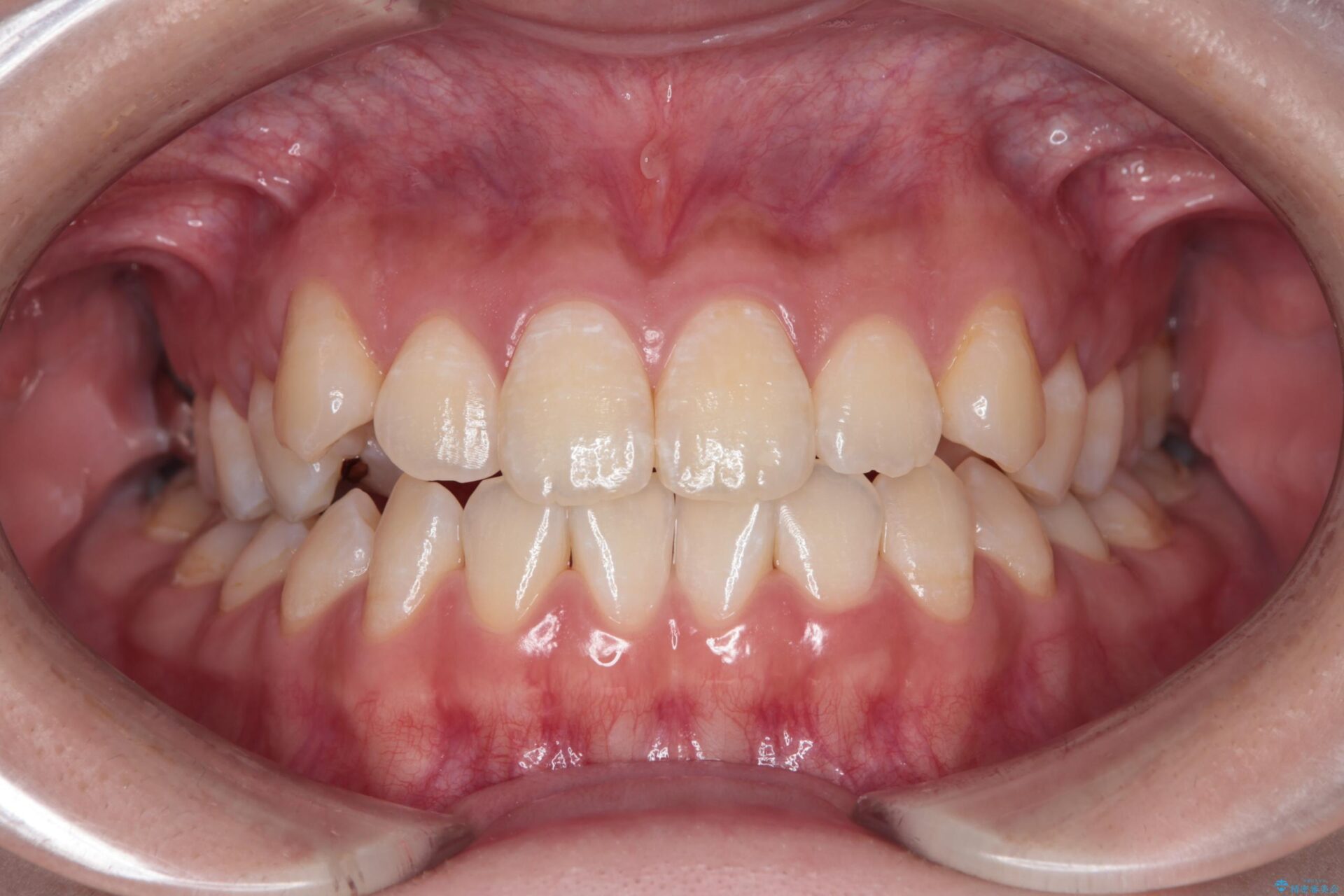 八重歯とがたつきを審美ワイヤーで治す 治療前