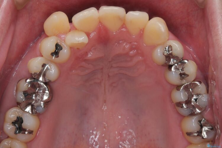 1本のみの抜歯でワイヤー矯正 治療前画像