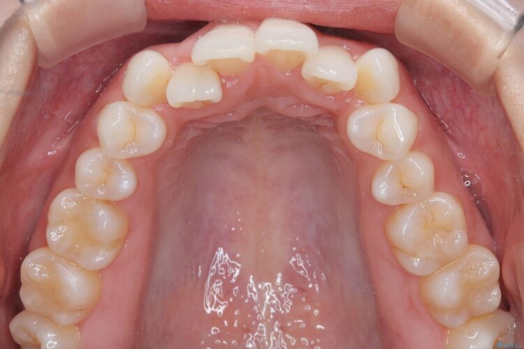 非抜歯で八重歯の改善 治療前画像