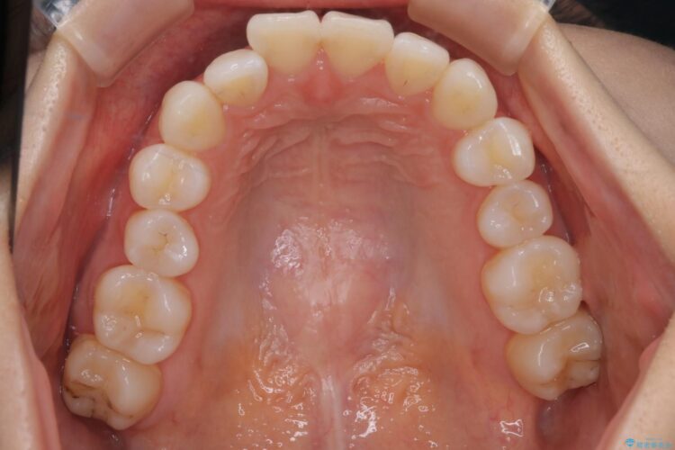 インビザラインで右側のガタつきの改善 治療前画像