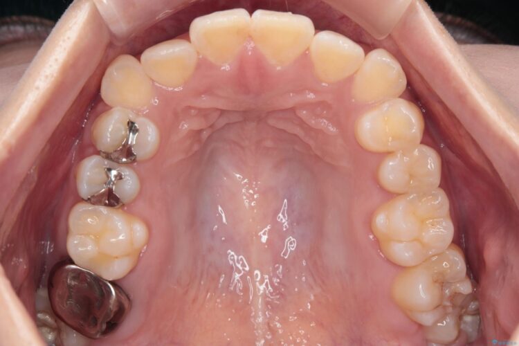 八重歯とがたつきを審美ワイヤーで治す 治療前画像