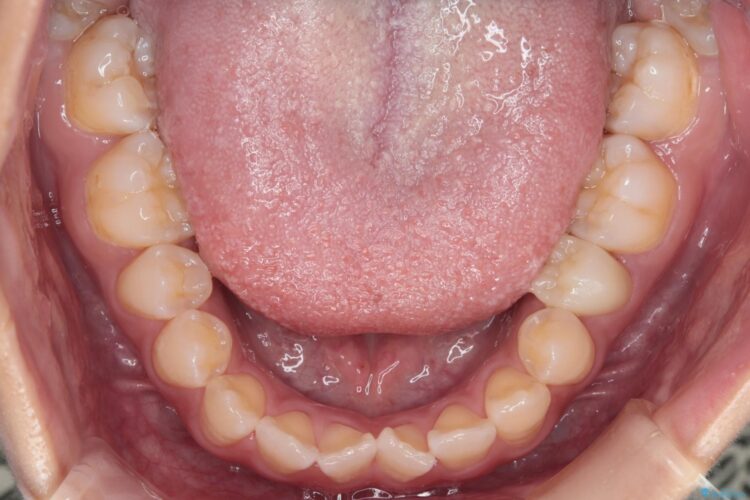 八重歯とがたつきを審美ワイヤーで治す 治療前画像