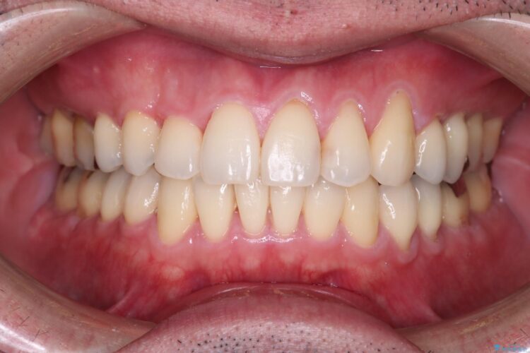 1本のみの抜歯でワイヤー矯正 アフター