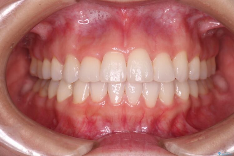 非抜歯で八重歯の改善 アフター