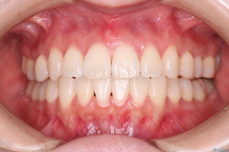 インビザラインで右側のガタつきの改善 アフター