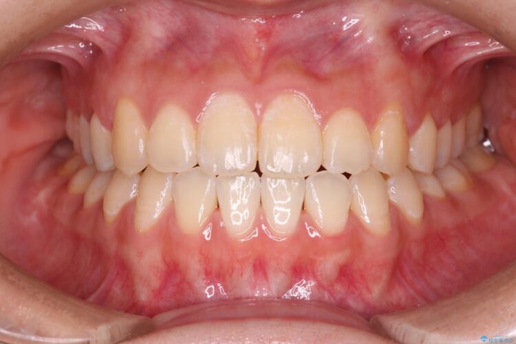 八重歯とがたつきを審美ワイヤーで治す アフター