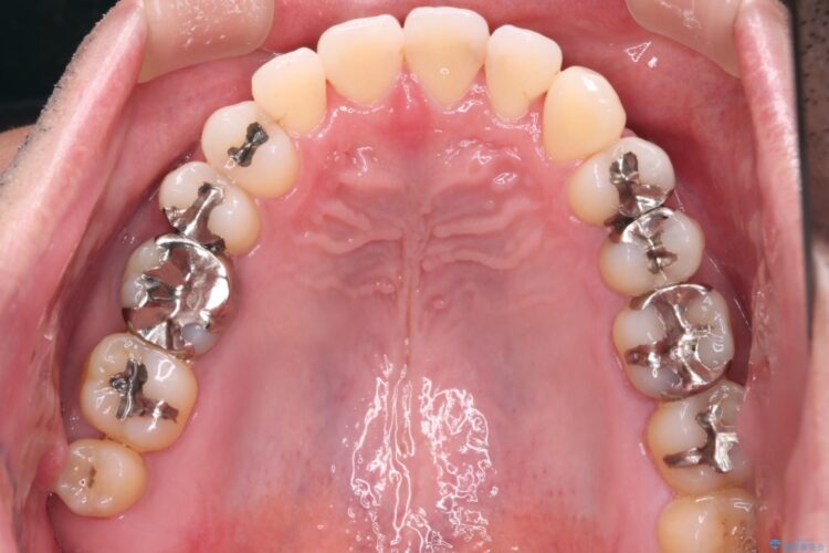 1本のみの抜歯でワイヤー矯正 治療後画像