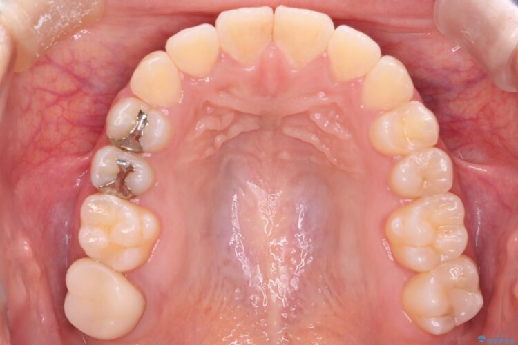 八重歯とがたつきを審美ワイヤーで治す 治療後画像