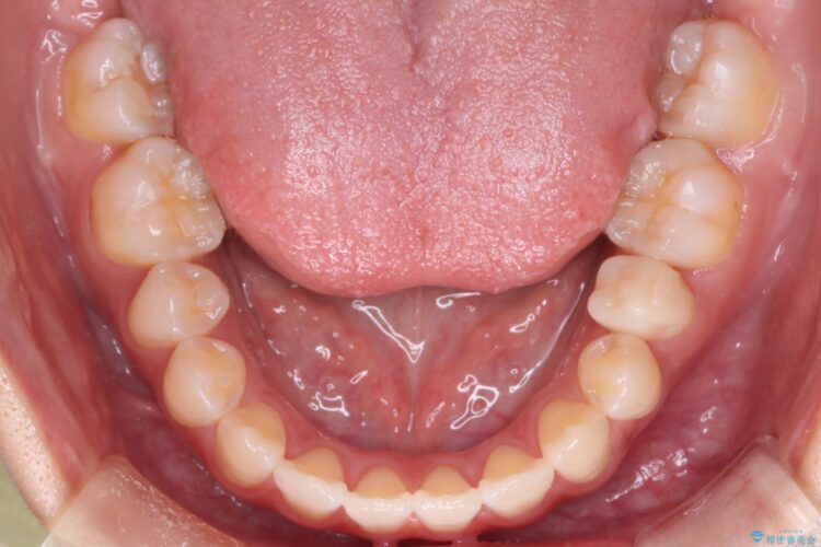 八重歯とがたつきを審美ワイヤーで治す 治療後画像