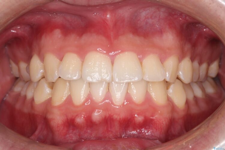 はじめてのオフィスホワイトニング 治療前画像