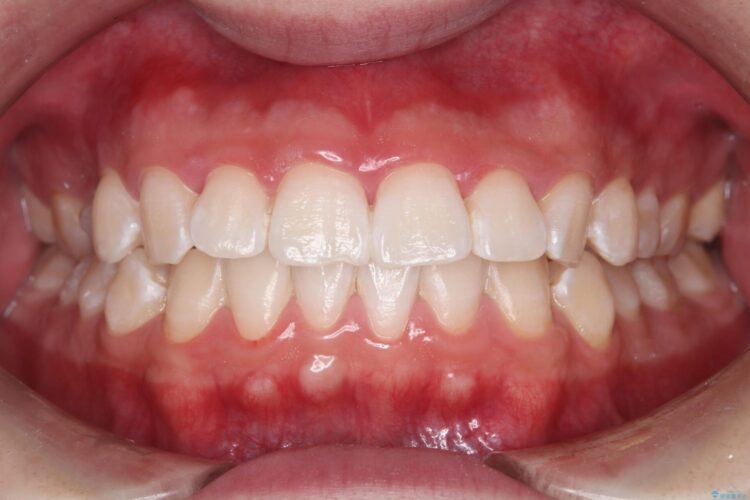 はじめてのオフィスホワイトニング 治療後画像