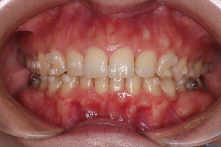 コンビネーション矯正でがたつきと噛み合わせを改善 治療途中画像