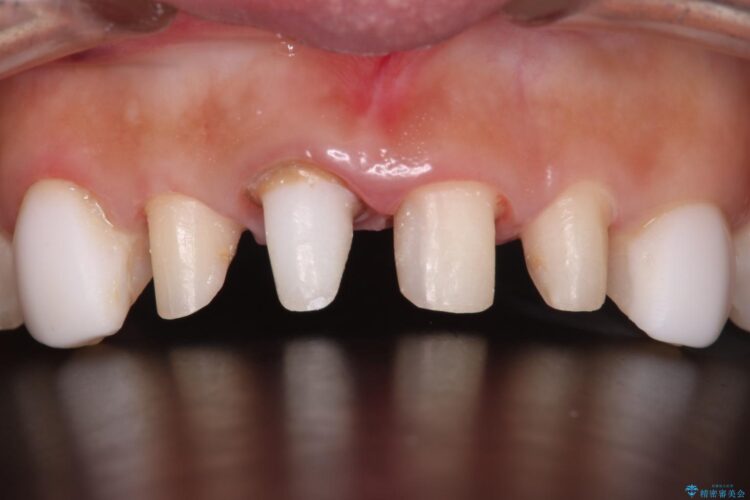 オールセラミッククラウンで歯の色を合わせたい 治療途中画像