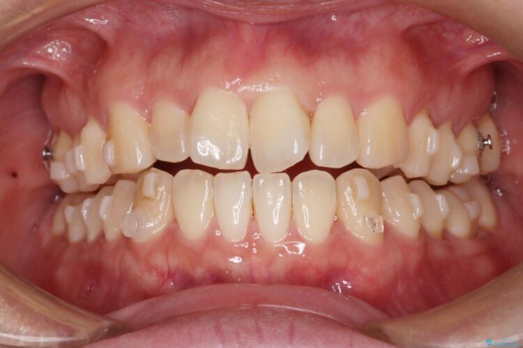 気になる前歯のねじれをインビザラインで改善 治療途中画像