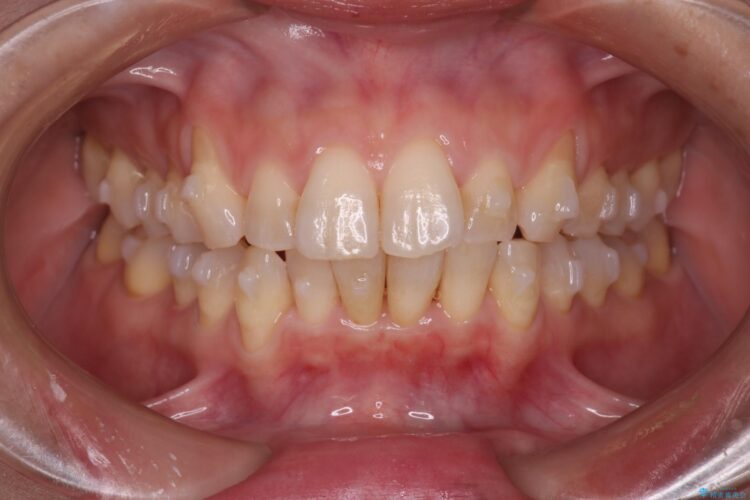 気になる出っ歯とガタつきの改善 治療途中画像