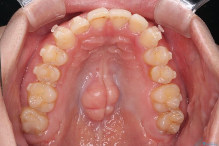 コンビネーション矯正でがたつきと噛み合わせを改善 治療途中画像