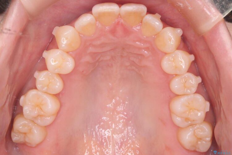 気になる出っ歯とガタつきの改善 治療途中画像