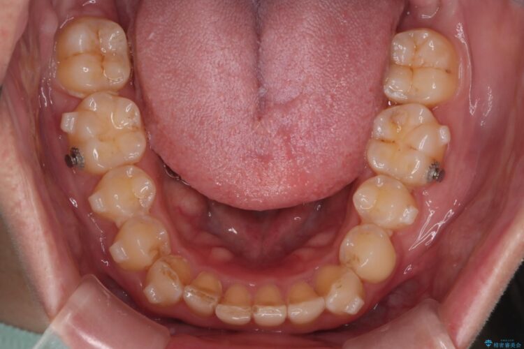 コンビネーション矯正でがたつきと噛み合わせを改善 治療途中画像