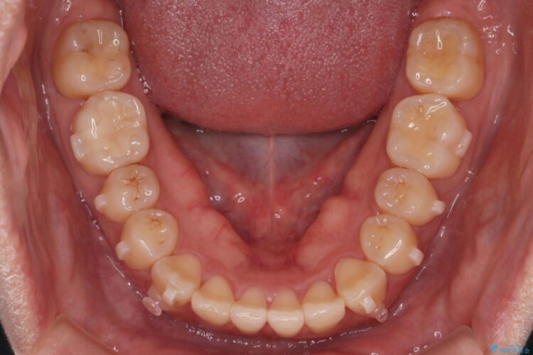 気になる前歯のねじれをインビザラインで改善 治療途中画像