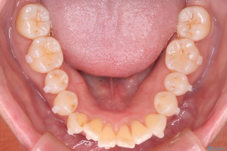 気になる出っ歯とガタつきの改善 治療途中画像