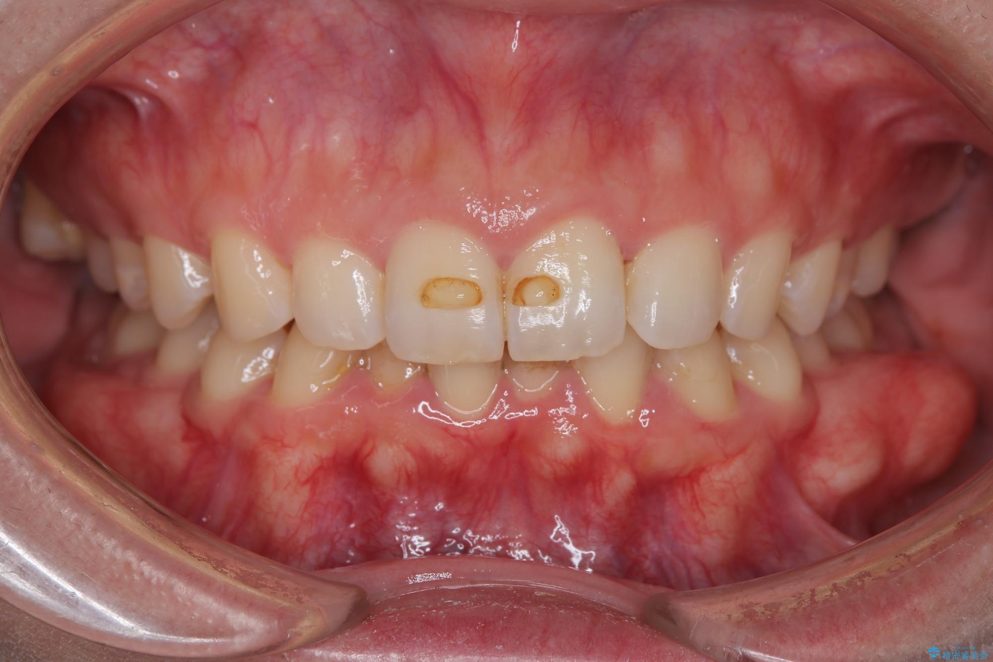 コンビネーション矯正でがたつきと噛み合わせを改善 治療前
