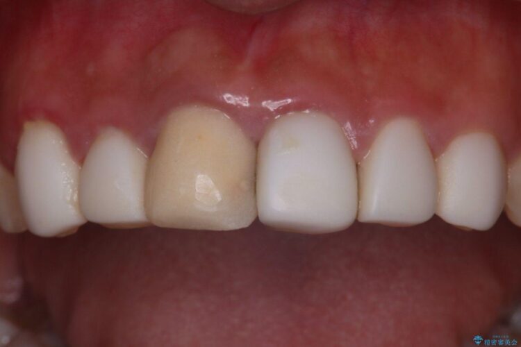 オールセラミッククラウンで歯の色を合わせたい 治療前画像